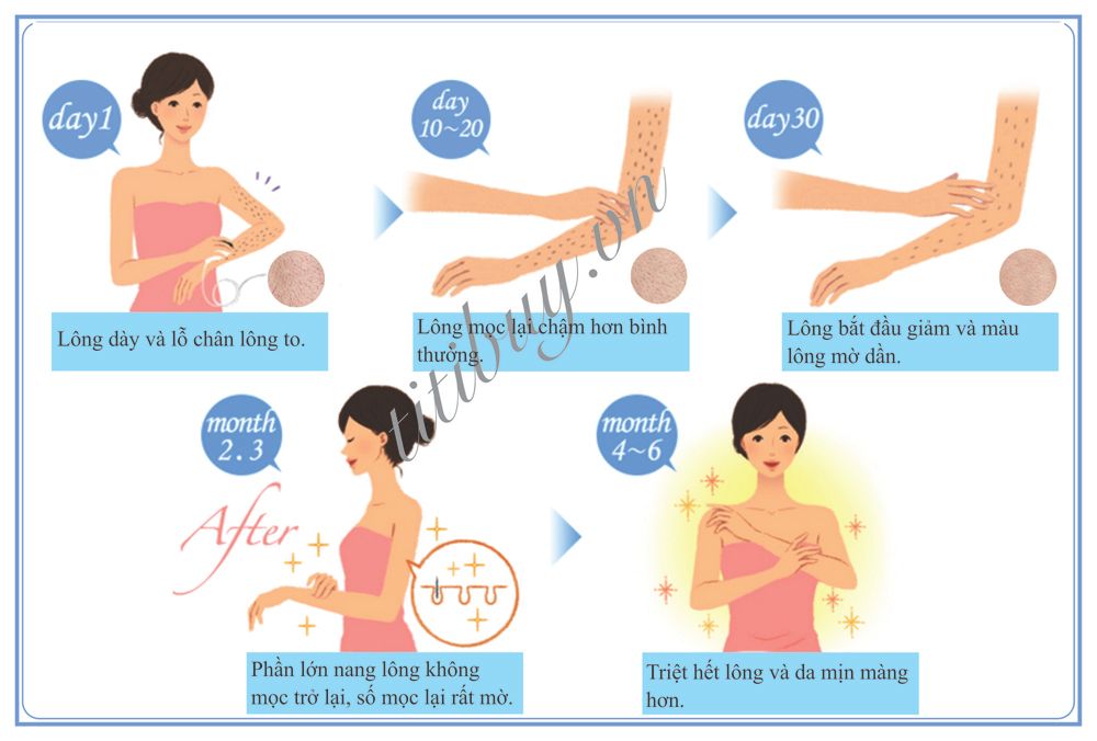 máy triệt lông tại nhà Nhật Bản